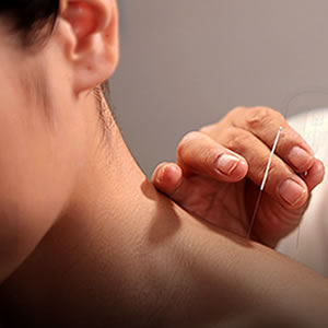 Chinese Acupuncture